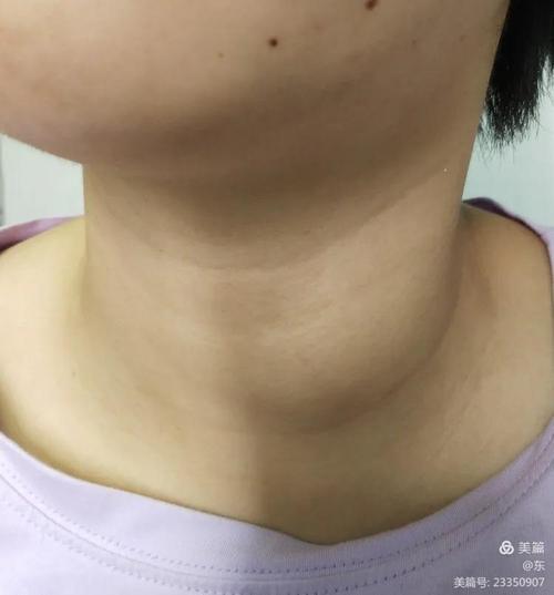 甲状腺结节射频消融治疗分享