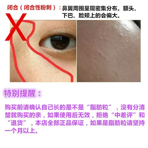 tsubu night pack去脂肪粒特效眼霜30g祛闭口痘痘膏日本速购