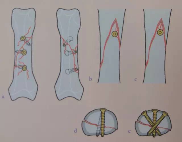 近节指骨螺旋形骨折:拉力螺钉