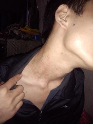 各位皮肤医生老师好,我想问一下我这个脖子上长的是什么,都好多天了也