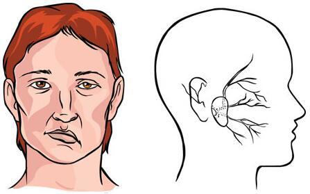 病情轻重影响面部神经炎治疗时间