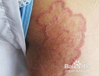 在家中如何治疗股癣用什么药