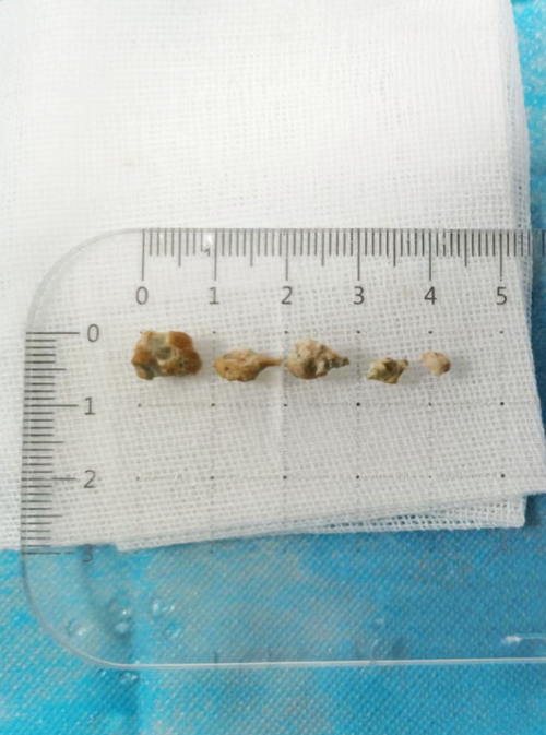 竟是支气管长结石了