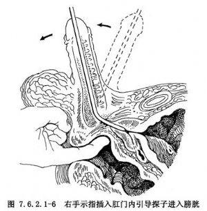 尿道狭窄扩张术