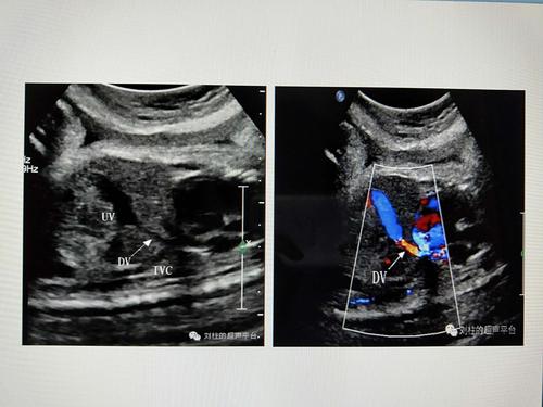 一,静脉导管解剖生理