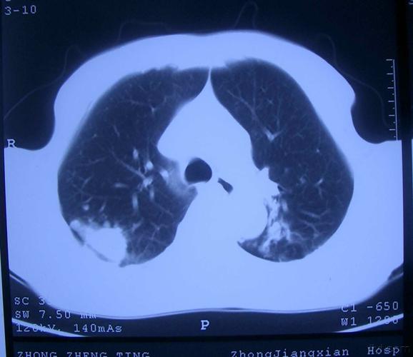 又一个病例讨论-咳嗽,黄痰,肺部阴影