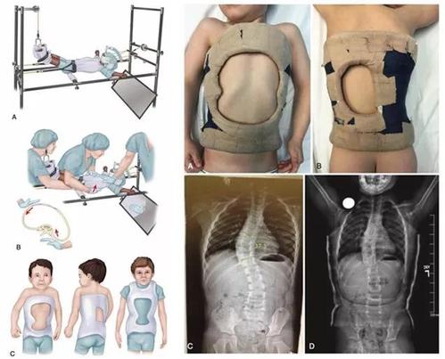 脊柱侧弯支具脊柱侧弯的紧箍咒特别是特发性脊柱侧弯效果杠杠