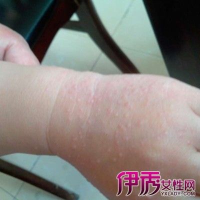 【图】幼儿皮疹图片大全 让你了解什么是皮疹