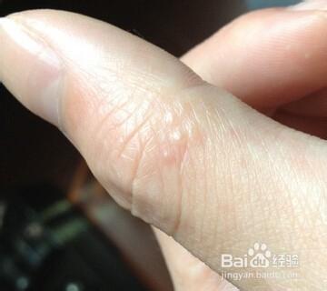 最终把毛孔撑破,汗液刺激皮肤,形成水泡,故称汗疱疹; 汗疱疹是湿疹的