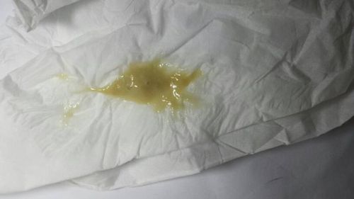 吸烟者痰中出现这物必是哮喘