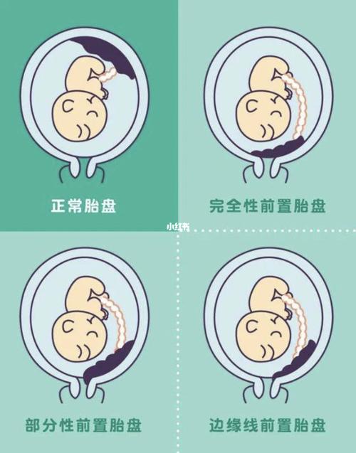 完全性前置胎盘_胎盘_产科_孕期_胎儿_怀孕_运动_前置