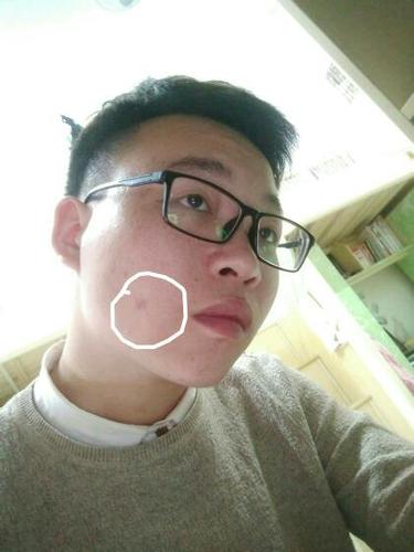 脸上痘印问题