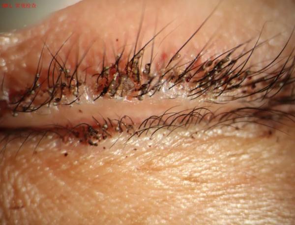 "裂隙灯下看到她双眼睫毛根部趴着数十只阴虱,睫毛上还沾满了虫卵,有