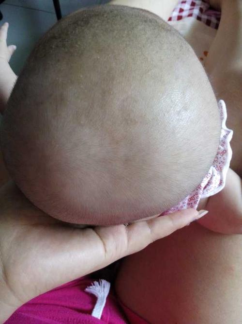 宝宝四个月了,后脑勺一边高一边低还可以纠正过来吗?担心