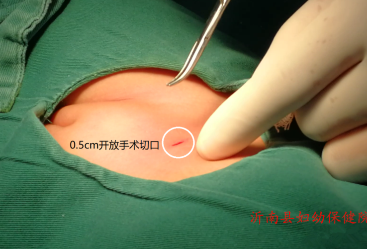 儿童腹股沟疝的微创治疗