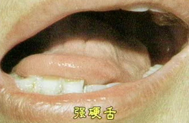 舌体板硬疆直,不能转动,为强硬舌.