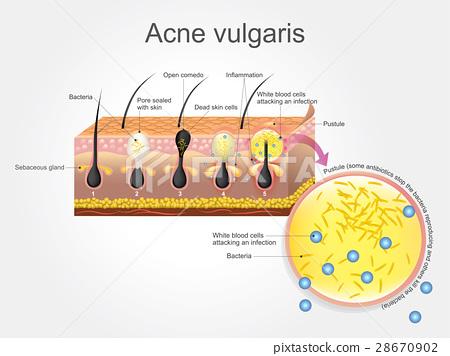 插图素材: acne vulgaris 查看全部