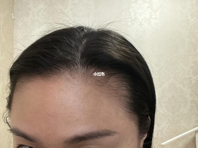 米诺第85天,发际线对比_发际线_新年去哪玩_美妆_个人