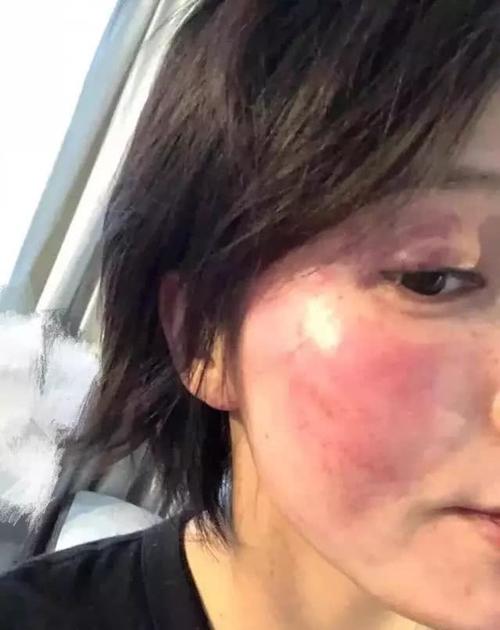 爆料黄景瑜丑闻的博主也发了一张王雨馨半张脸红肿的照片.