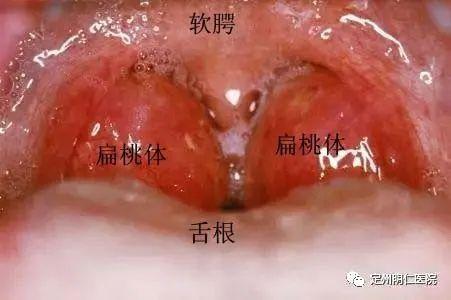 局部检查时如发现扁桃体及腭舌弓慢性充血,扁桃体表面凹凸不平,有瘢痕
