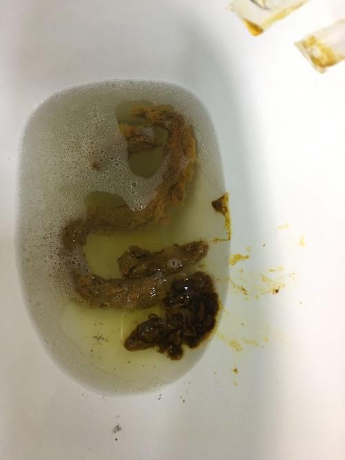 大便前边还算成型后面有一段不成形有点黑挺稀还有黏液