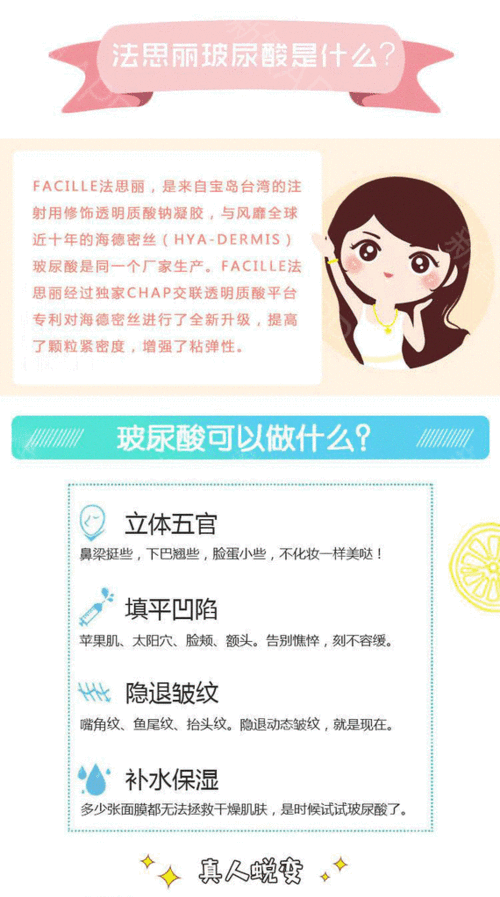 【玻尿酸】法思丽 法思丽 1ml ,法思丽大分子玻尿酸1ml 适合全脸填充