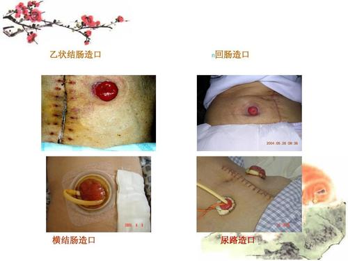 第14页 (共56页,当前第14页) 你可能喜欢 回肠造口护理 直肠癌护理