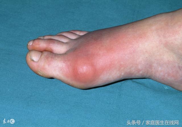 经常吃这两种食物,难怪痛风一直好不了