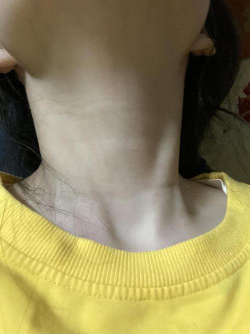 我感觉好像甲状腺那里肿了一块