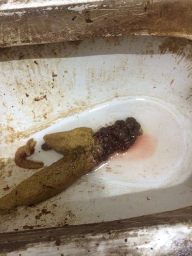 为什么会拉出这样的屎 医生?