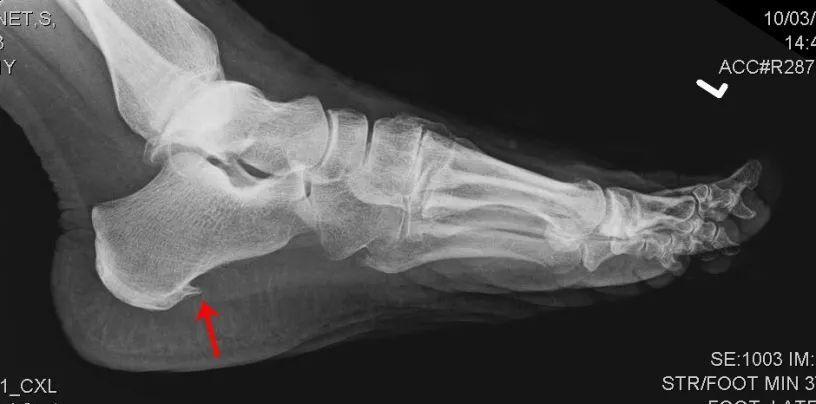 有跑友到医院检查,拍片后显示有跟骨骨刺(专业术语称为跟骨骨赘),大