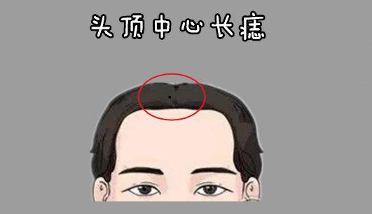 头顶中心长痣