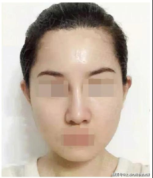 韦敏案例实讲丨成功的颧弓下颌角如何减龄