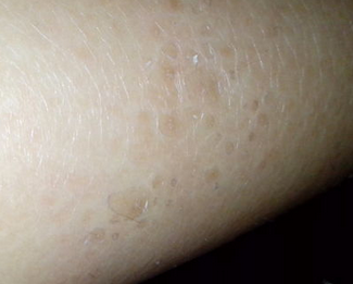 鱼鳞病能要小孩吗