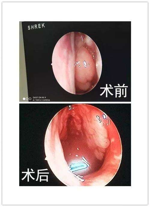 儿童腺样体肥大危害大 预防保健最重要