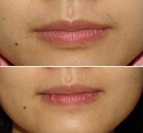 冰点脱唇毛前后对比图