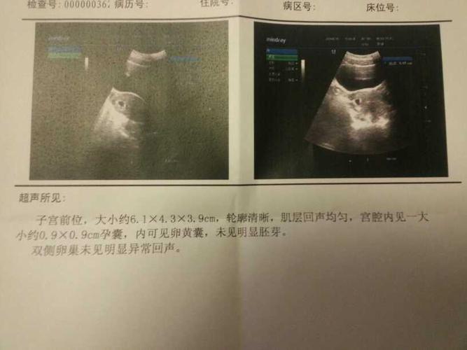 【45天男孩胎囊】40-50天孕检胎囊大小可以看男女!