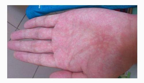 2, 出现肝腹水,肚子变大如蛙状