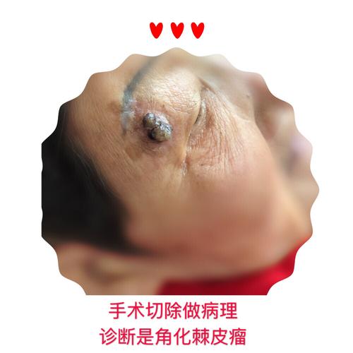 手术切除做病理,诊断是角化棘皮瘤