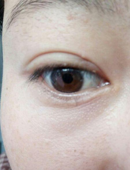 睫毛根部小颗粒是什么啊,不痛不痒,没有感觉,但一直都