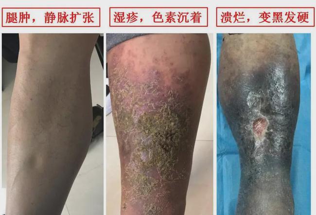 腿部"青筋凸起",小心下肢静脉曲张!|溃疡|血管|瓣膜