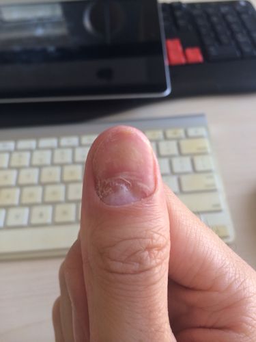 我这个指甲盖怎么了?