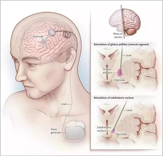 原来这些疾病都可以利用脑起搏器治疗