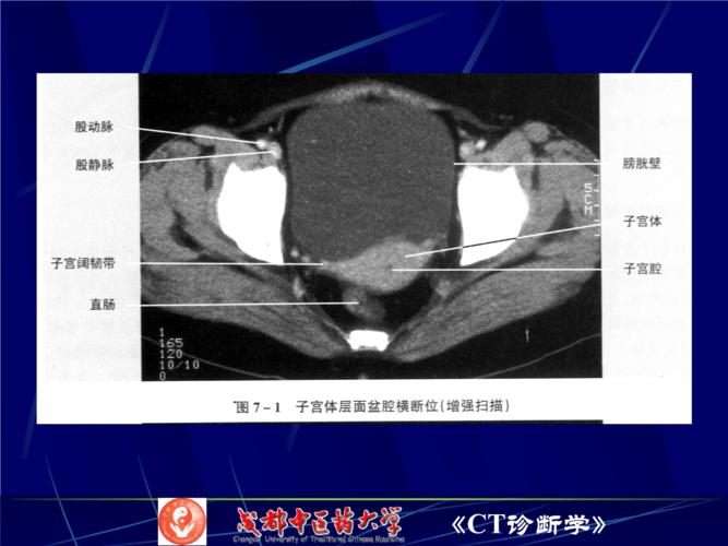 培训课件-盆腔ct检查.ppt