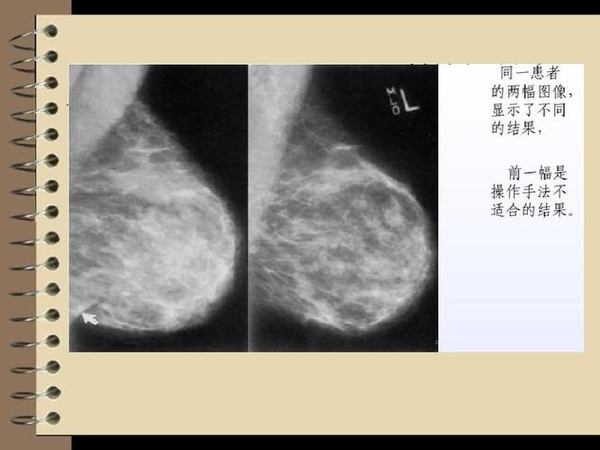 乳腺x线摄影技术