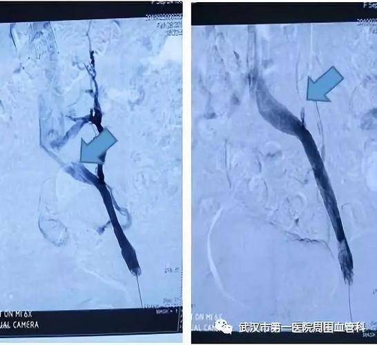 下肢静脉回流障碍----重视髂静脉受压综合征筛查和治疗