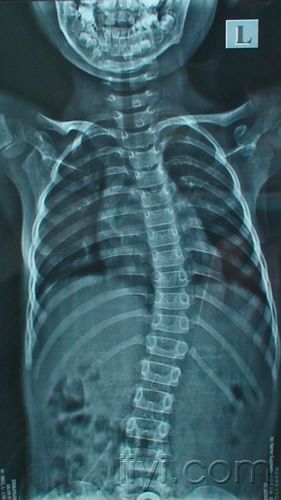 请专家们看看六岁小女孩的脊柱片子