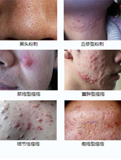 滚蛋吧,痘痘君!超全战痘攻略千万别错过!