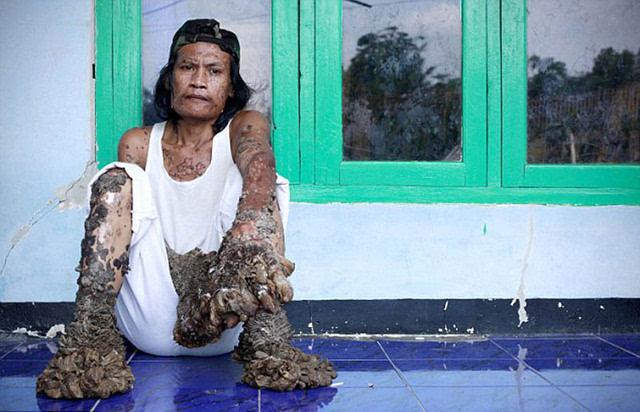 印尼"树人"抱憾去世 至死未能治愈怪病(组图)