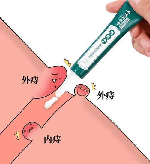 得了痔疮到底有多羞耻